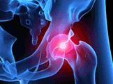 De Puy Hip Replacement Verdict De Puy Hip Replacement Verdict