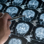Misdiagnosed Brain Cancer